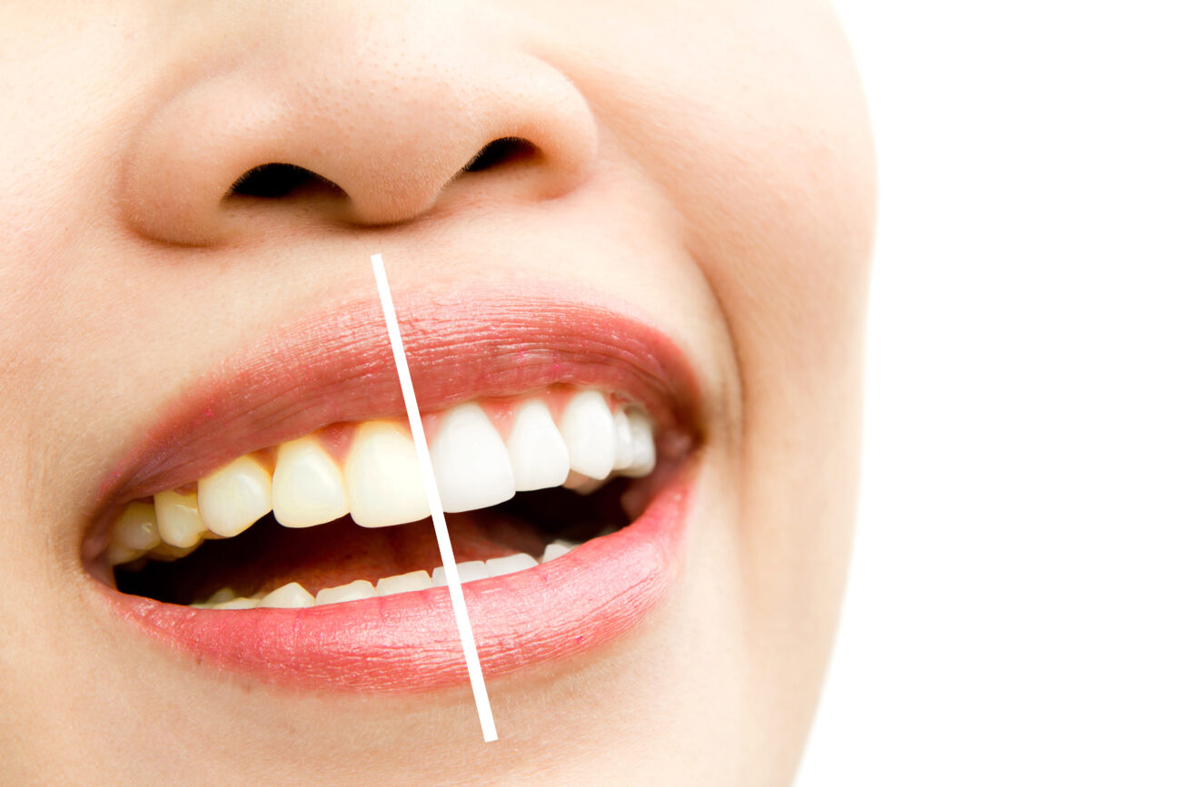 Brighter Smiles Start Here - Our Top Teeth Whitening Tips