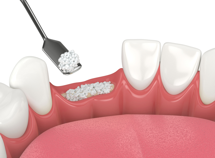 Bone Grafting Elmhurst