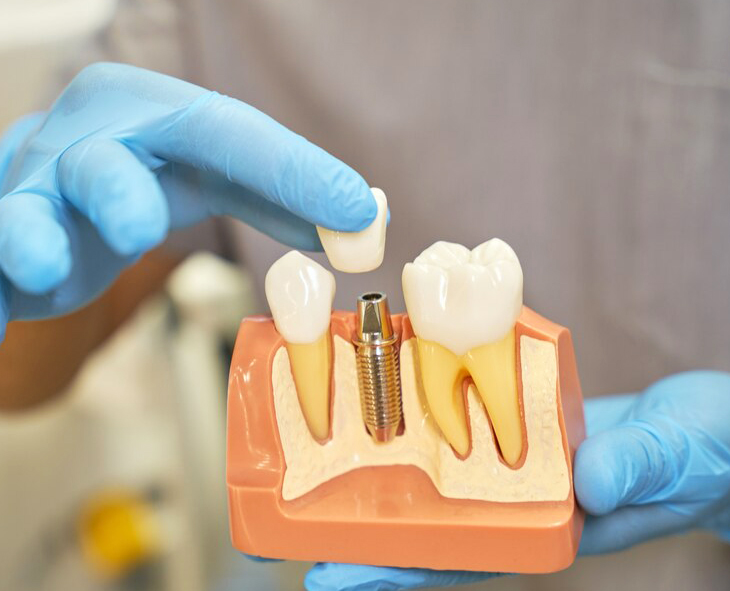 Dental Implant Elmhurst 