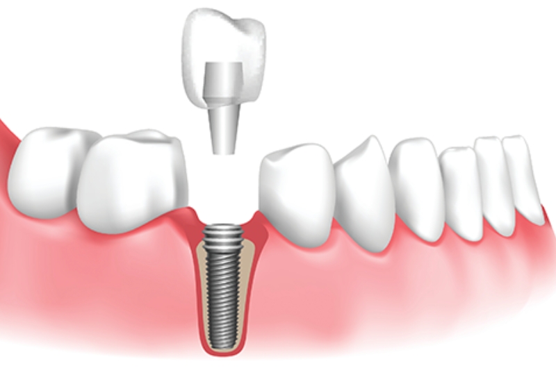 Dental Implants in Elmhurst, IL