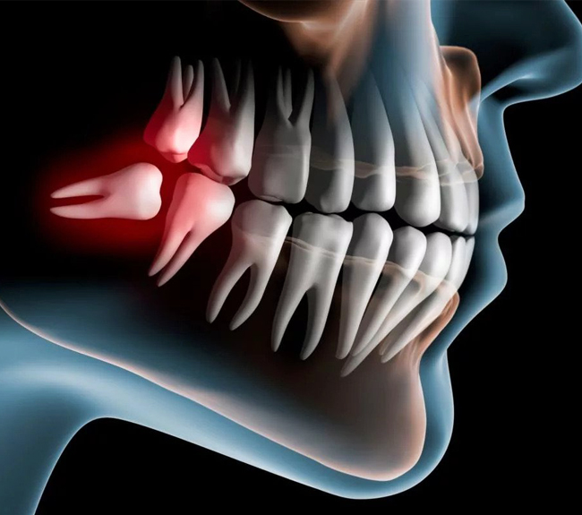 What is Wisdom Teeth Extraction