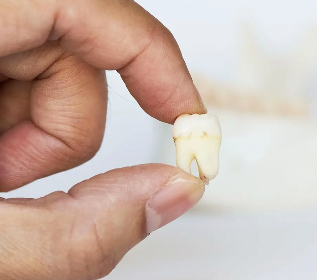 Why Need Wisdom Teeth Extraction