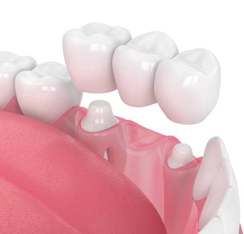 dental crowns elmhurst il