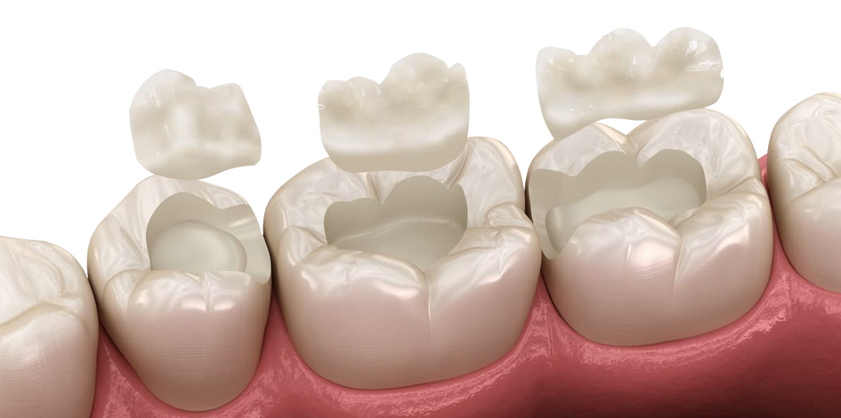 dental inlays and onlays elmhurst il