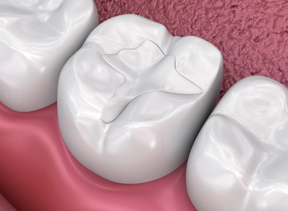 fillings elmhurst il