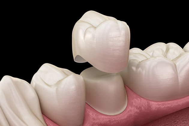 WHAT ARE DENTAL CROWNS