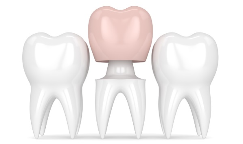 Broken Crown Repaired or Replaced