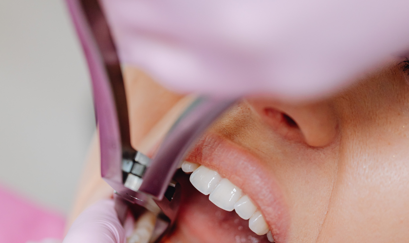 What To Eat After Tooth Extraction