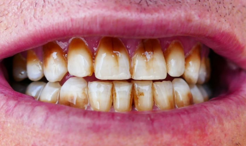 Ways to remove coffee stains from your teeth