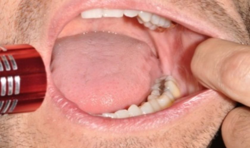 What Is The Purpose Of Oral Cancer Screening