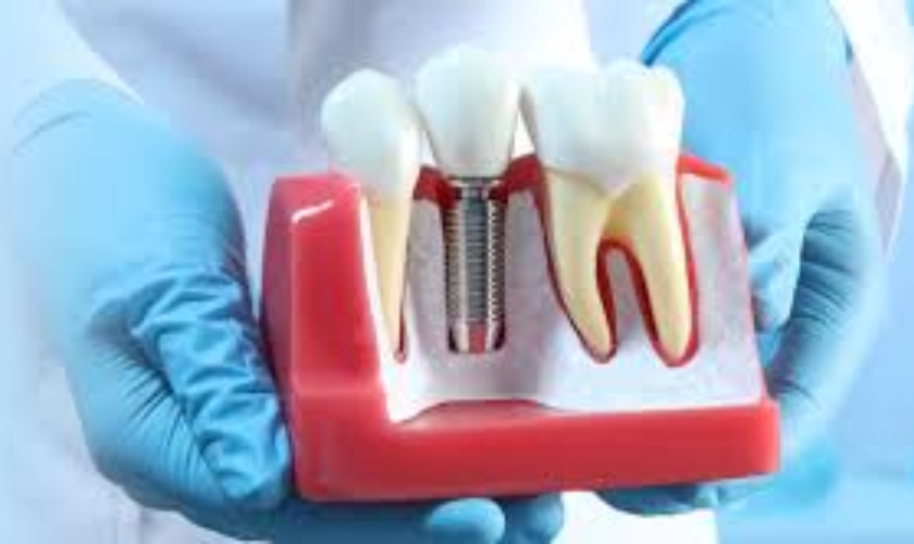 What are the benefits and procedures involved in dental implants