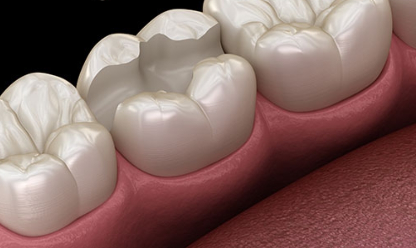 signs you might need an inlays or onlays