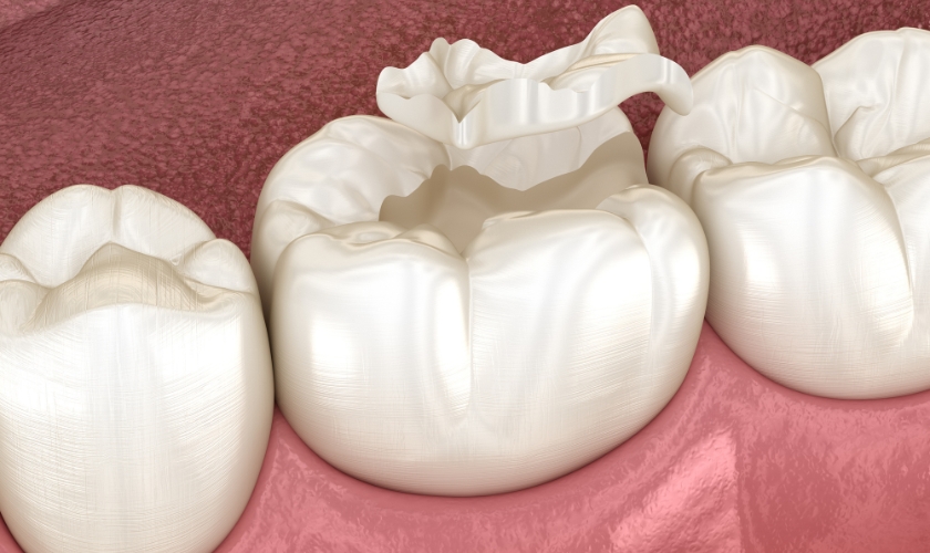 tips for caring for your dental inlays and onlays