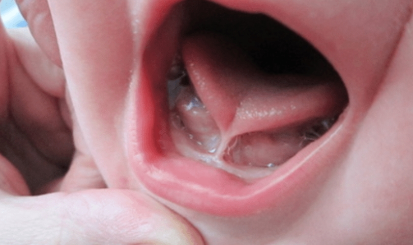 best procedure for tongue tie