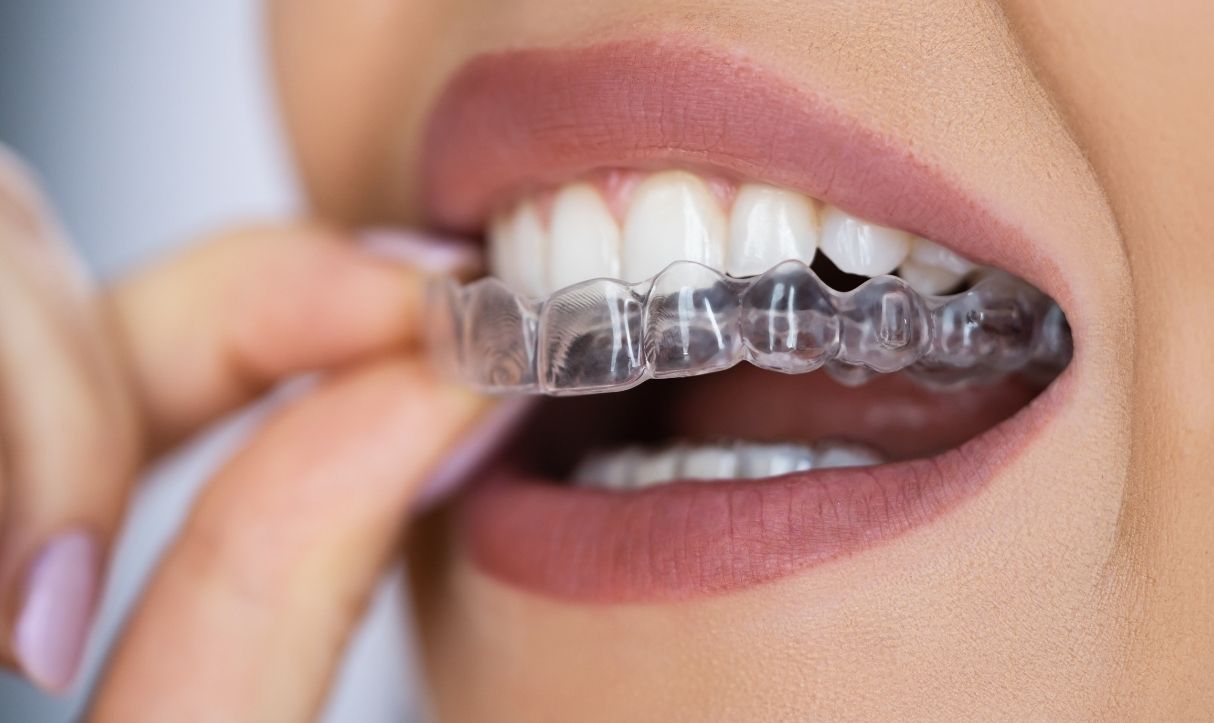tips for travelers with clear aligners to stay on track
