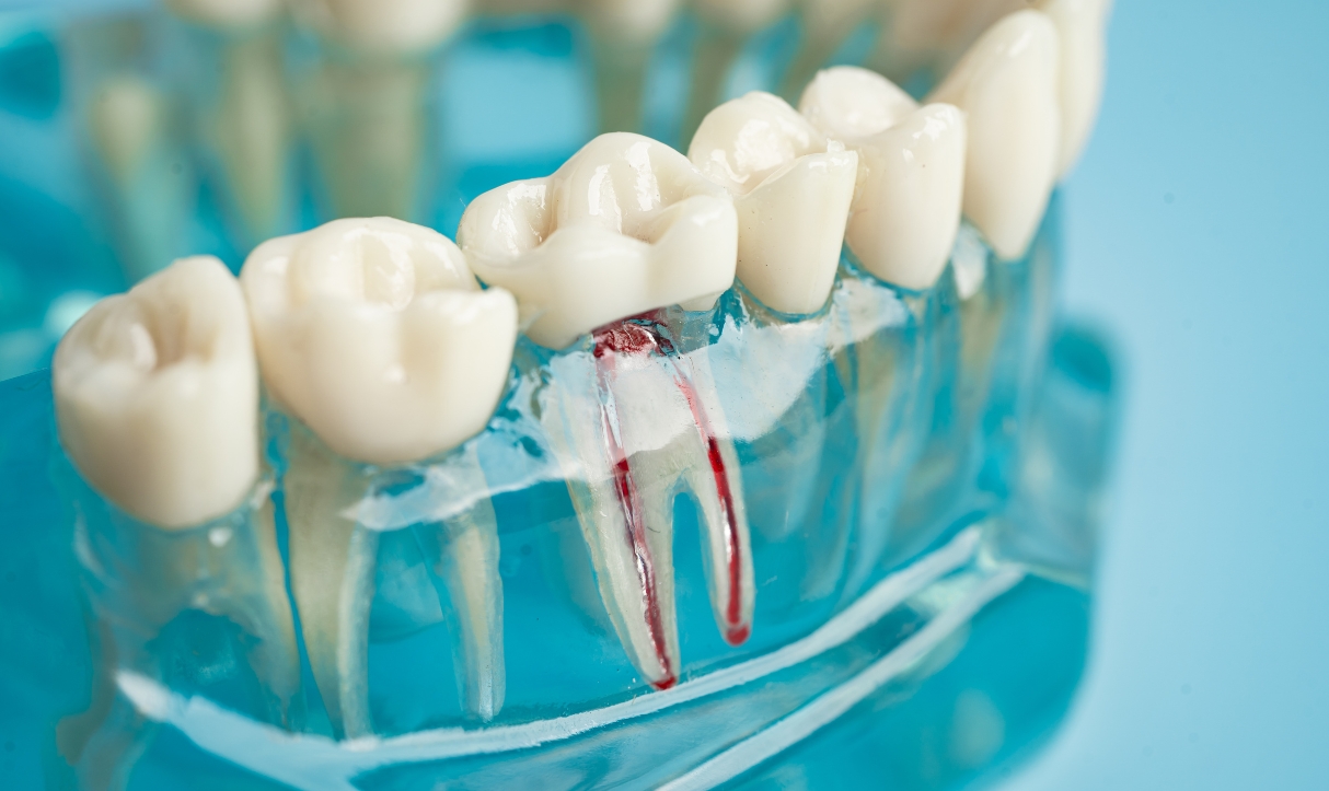 how you can relieve pain after getting root canal treatment