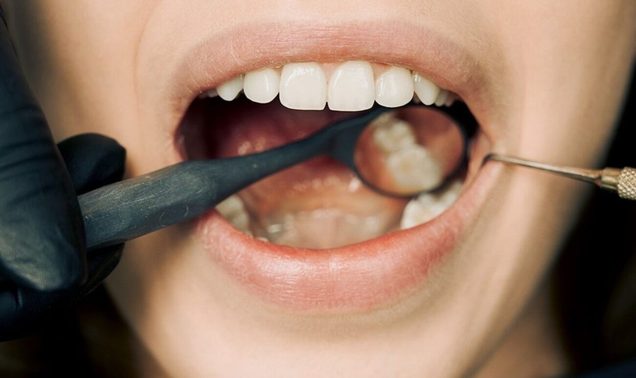 how long it takes to recover from wisdom teeth surgery