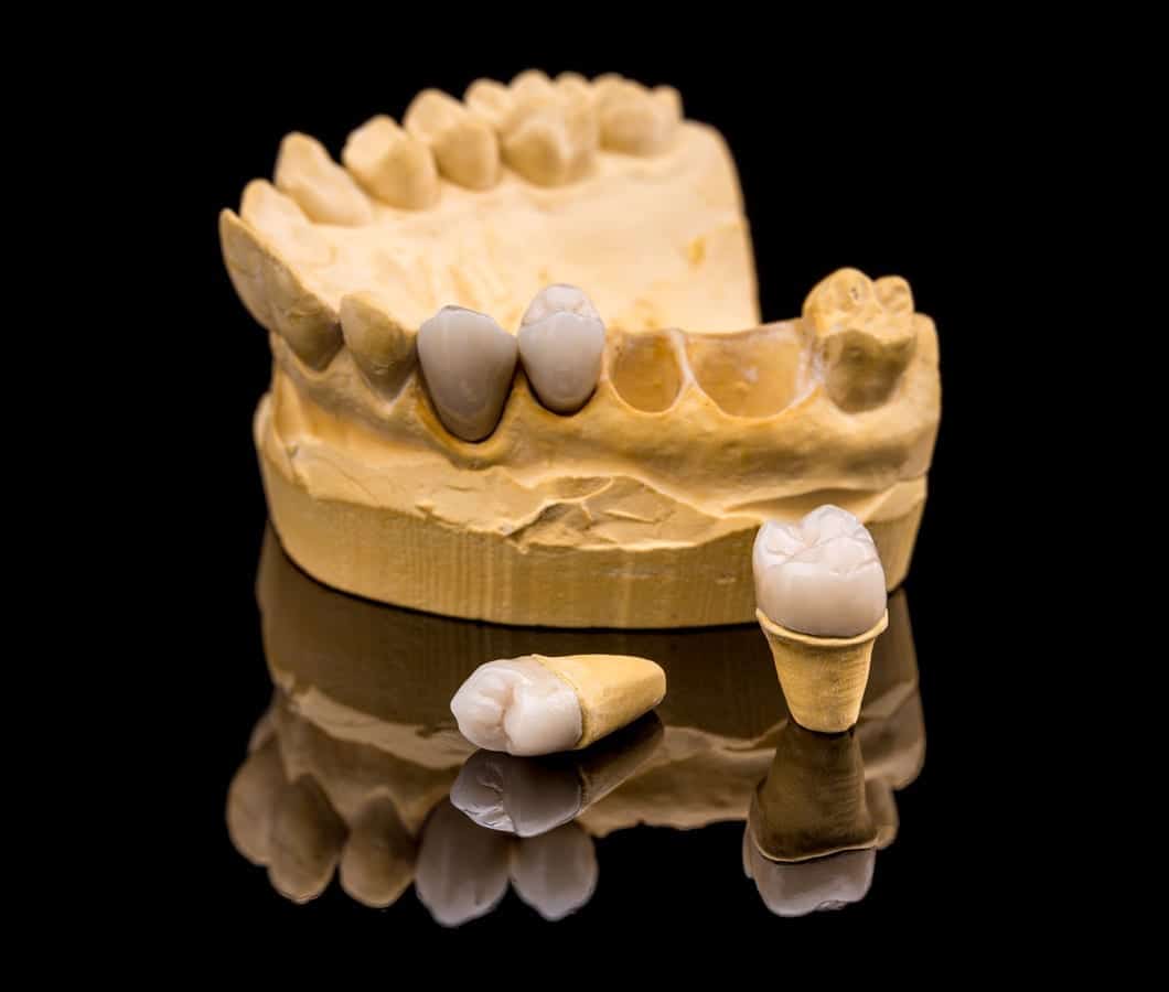 Dental Crowns in Berkeley